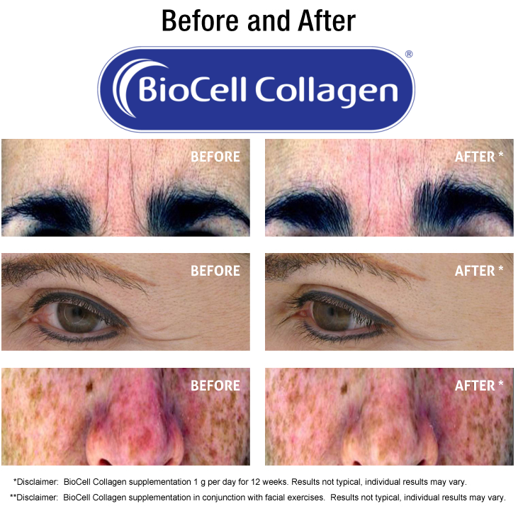 Before and After BioCell Collagen